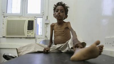 A 5 year old boy on a hospital bed in Yemen