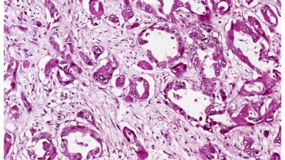 Light micrograph of tissue from a pancreas in a case of pancreatic cancer.