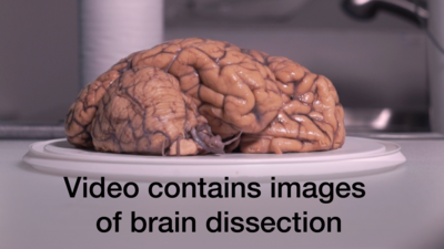 Video demonstrating a brain dissection