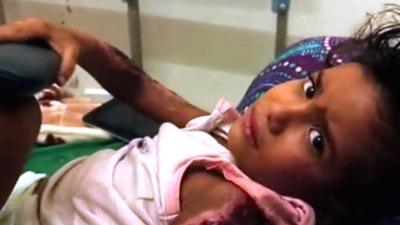 Girl injured by airstrike, recovering in hospital in Sanaa