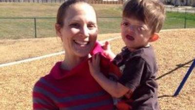 A mother and her son who has Pfeifer Syndrome