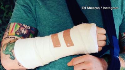 Ed Sheeran arm injury in cycling accident