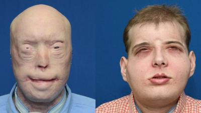 Patrick Hardiman before and after surgery