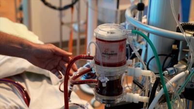 An ECMO