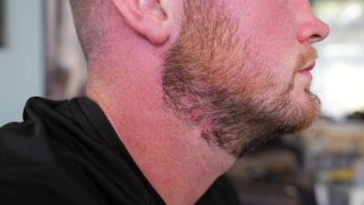Man with a beard facing sideways. There is a red mark where the sepsis spot used to be.