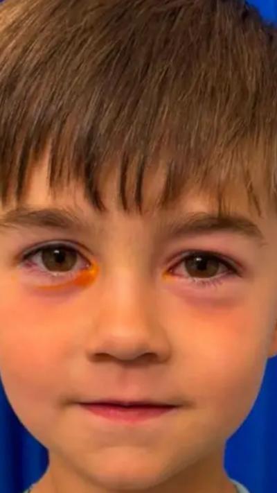 A boy with injured eyes looking at a camera