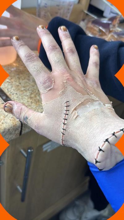 The hand of actor Victor Dorobantu, with make-up and prosthetics so it looks like he has dirty nails and scars