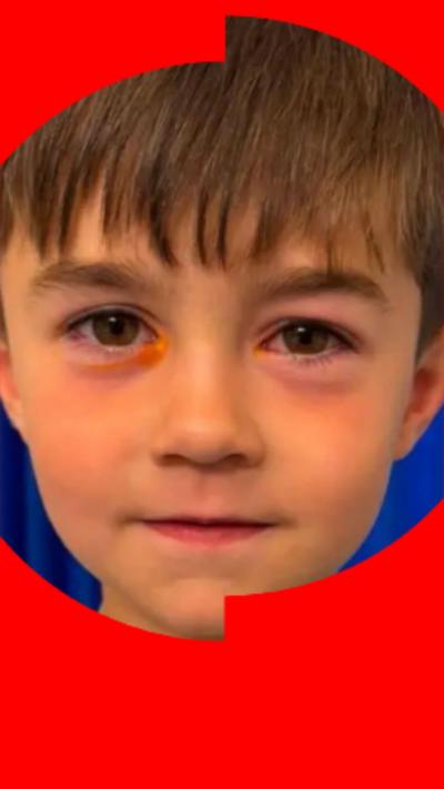 Hudson, a young boy seen with major irritation around his eyes. His left eye has a swollen and bruised colour to it underneath the retina. His right eye has an orange tint underneath.