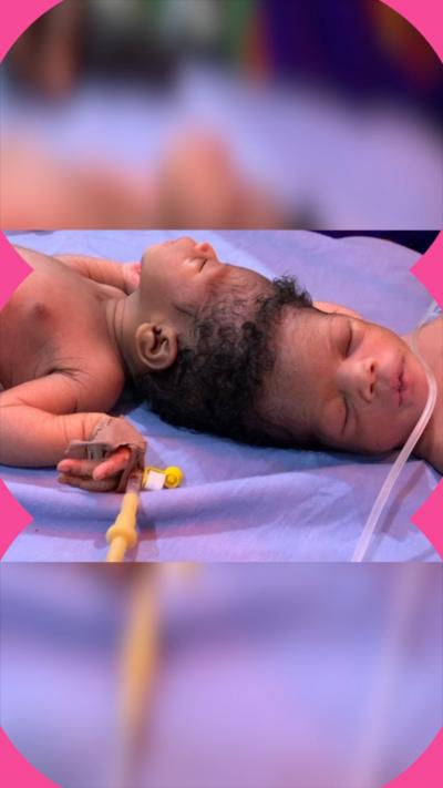 Two babies, joined at the top of their head, lie on a hospital bed