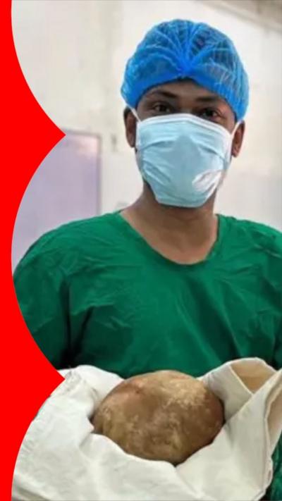 A doctor wearing a blue hair net, a face mask and green scrubs, holds a giant bladder stone in a white cloth.