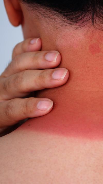 Close up of the back of a very red-looking, sunburnt neck