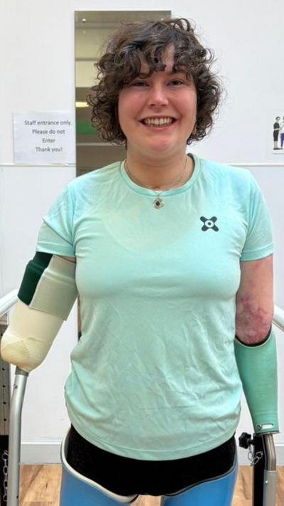 A young woman who has lost her lower arms, faces the camera and smiles as she undergoes rehab