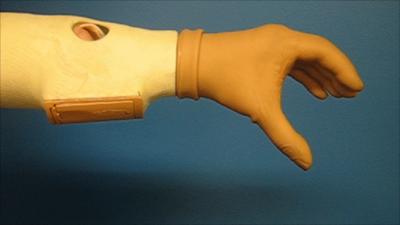 The bionic arm fitted after amputation