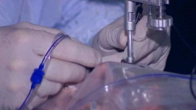 Surgery on the eye