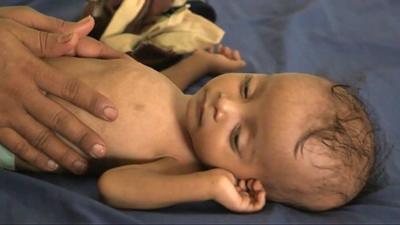 A children suffering from malnutrition in Yemen
