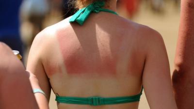 A woman with sunburn