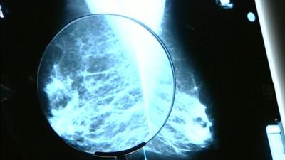 Breast x-ray