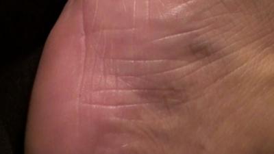 Skin with potential bed sore