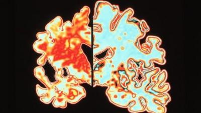 Scan of a brain of an Alzheimer's patient which shows significant signs of shrinking compared to an normal brain.