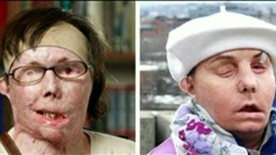 Carmel Blandin Tarleton, before and after the transplant