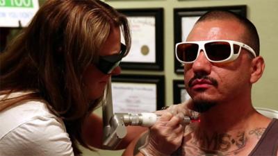 An ex-gangster gets a gang tattoo removed