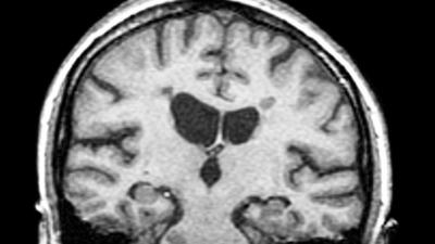 MRI scan of multiple sclerosis patient