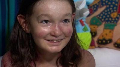 Sohana Collins who suffers from Epidermolysis bullosa (EB)