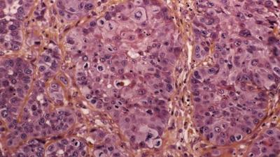 Cells taken from an oesophagus cancer patient