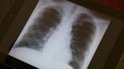 X-ray of lungs