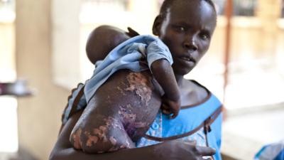 A woman holding her severely malnourished baby in the malnutrition ward of the El Sabbah Pediatric Hospital in Juba, S Sudan, 14 March 2014 AFP