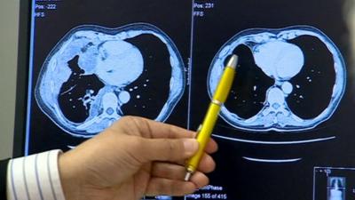 Scans show reduction in cancer tumour size