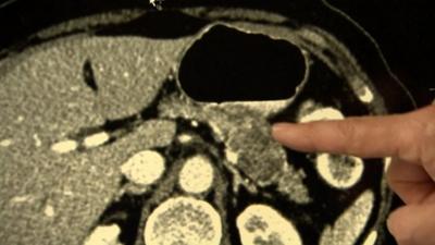 Tumour on pancreas