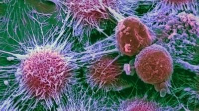 Kidney cancer cells