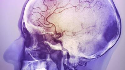 Coloured angiogram of the brain of a 48 year old patient after a massive cerebrovascular accident (CVA), or stroke