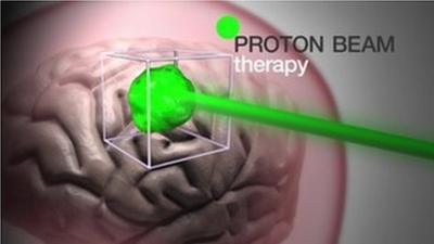 Graphic illustrating how proton beam therapy works