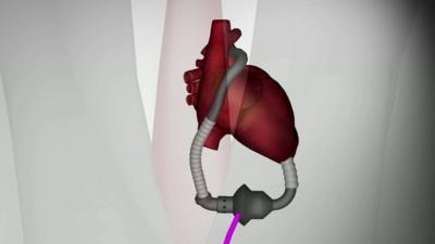 Graphic showing device and heart