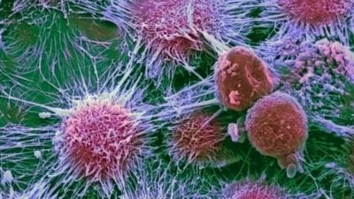 Kidney cancer cells