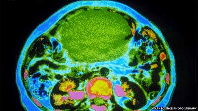 CT scan showing ovarian cancer growth (in green)