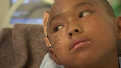 Twelve year old Nangsal Tamang being treated at an Israeli military hospital in Kathmandu.