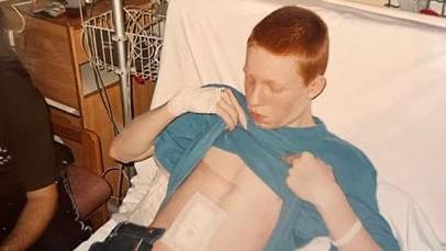 A boy with short red hair is in a hospital bed. He is lifting up a blue T-shirt and looking at a surgical covering on his chest.