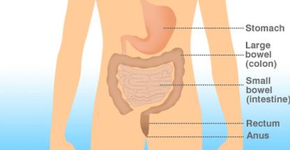 Bowel cancer