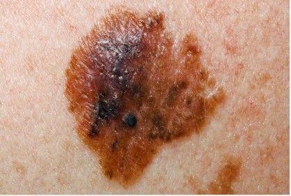 Melanoma