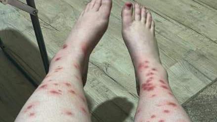 A woman's legs showing several insect bites