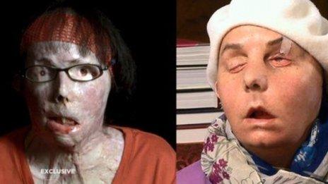 Carmen Blandin Tarleton shown after the attack (l), and after her face transplant (r)