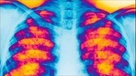 Cystic fibrosis x-ray