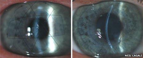 Images of the biosynthetic cornea post surgery after 24 hours and 2 years.