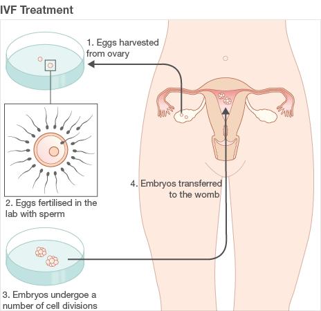 Graphic: How IVF treatment works