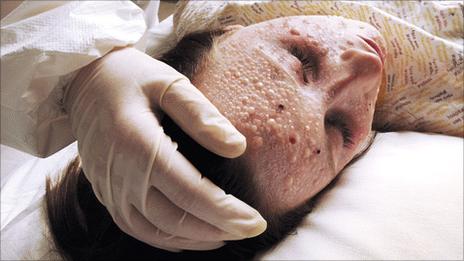 Smallpox infection