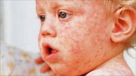 Boy with measles