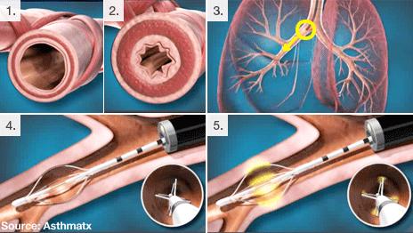 Images showing asthma treatment